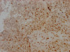 IHC image of CSB-RA230110A0HU diluted at 1:100 and staining in paraffin-embedded human cervical cancer performed on a Leica BondTM system. After dewaxing and hydration, antigen retrieval was mediated by high pressure in a citrate buffer (pH 6.0). Section was blocked with 10% normal goat serum 30min at RT. Then primary antibody (1% BSA) was incubated at 4°C overnight. The primary is detected by a Goat anti-rabbit IgG polymer labeled by HRP and visualized using 0.05% DAB.