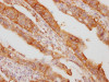 IHC image of CSB-RA932542A0HU diluted at 1:100 and staining in paraffin-embedded human colon cancer performed on a Leica BondTM system. After dewaxing and hydration, antigen retrieval was mediated by high pressure in a citrate buffer (pH 6.0). Section was blocked with 10% normal goat serum 30min at RT. Then primary antibody (1% BSA) was incubated at 4°C overnight. The primary is detected by a Goat anti-rabbit IgG polymer labeled by HRP and visualized using 0.05% DAB.