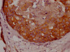 IHC image of CSB-RA951649A0HU diluted at 1:100 and staining in paraffin-embedded human breast cancer performed on a Leica BondTM system. After dewaxing and hydration, antigen retrieval was mediated by high pressure in a citrate buffer (pH 6.0). Section was blocked with 10% normal goat serum 30min at RT. Then primary antibody (1% BSA) was incubated at 4°C overnight. The primary is detected by a Goat anti-rabbit IgG polymer labeled by HRP and visualized using 0.05% DAB.