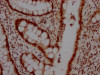 IHC image of CSB-RA792129A0HU diluted at 1:100 and staining in paraffin-embedded human colon cancer performed on a Leica BondTM system. After dewaxing and hydration, antigen retrieval was mediated by high pressure in a citrate buffer (pH 6.0). Section was blocked with 10% normal goat serum 30min at RT. Then primary antibody (1% BSA) was incubated at 4°C overnight. The primary is detected by a Goat anti-rabbit IgG polymer labeled by HRP and visualized using 0.05% DAB.