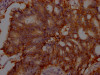 IHC image of CSB-RA439934A0HU diluted at 1:100 and staining in paraffin-embedded human colon cancer performed on a Leica BondTM system. After dewaxing and hydration, antigen retrieval was mediated by high pressure in a citrate buffer (pH 6.0). Section was blocked with 10% normal goat serum 30min at RT. Then primary antibody (1% BSA) was incubated at 4°C overnight. The primary is detected by a Goat anti-rabbit IgG polymer labeled by HRP and visualized using 0.05% DAB.