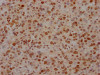 IHC image of CSB-RA157765A0HU diluted at 1:100 and staining in paraffin-embedded human glioma cancer performed on a Leica BondTM system. After dewaxing and hydration, antigen retrieval was mediated by high pressure in a citrate buffer (pH 6.0). Section was blocked with 10% normal goat serum 30min at RT. Then primary antibody (1% BSA) was incubated at 4°C overnight. The primary is detected by a Goat anti-rabbit IgG polymer labeled by HRP and visualized using 0.05% DAB.