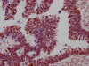 IHC image of CSB-RA149196A0HU diluted at 1:100 and staining in paraffin-embedded human ovarian cancer performed on a Leica BondTM system. After dewaxing and hydration, antigen retrieval was mediated by high pressure in a citrate buffer (pH 6.0). Section was blocked with 10% normal goat serum 30min at RT. Then primary antibody (1% BSA) was incubated at 4°C overnight. The primary is detected by a Goat anti-rabbit IgG polymer labeled by HRP and visualized using 0.05% DAB.