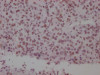 IHC image of CSB-RA149196A0HU diluted at 1:100 and staining in paraffin-embedded human glioma cancer performed on a Leica BondTM system. After dewaxing and hydration, antigen retrieval was mediated by high pressure in a citrate buffer (pH 6.0). Section was blocked with 10% normal goat serum 30min at RT. Then primary antibody (1% BSA) was incubated at 4°C overnight. The primary is detected by a Goat anti-rabbit IgG polymer labeled by HRP and visualized using 0.05% DAB.