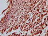 IHC image of CSB-RA592917A0HU diluted at 1:100 and staining in paraffin-embedded human melanoma cancer performed on a Leica BondTM system. After dewaxing and hydration, antigen retrieval was mediated by high pressure in a citrate buffer (pH 6.0). Section was blocked with 10% normal goat serum 30min at RT. Then primary antibody (1% BSA) was incubated at 4°C overnight. The primary is detected by a Goat anti-rabbit IgG polymer labeled by HRP and visualized using 0.05% DAB.
