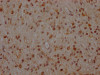 IHC image of CSB-RA957619A0HU diluted at 1:100 and staining in paraffin-embedded human glioma cancer performed on a Leica BondTM system. After dewaxing and hydration, antigen retrieval was mediated by high pressure in a citrate buffer (pH 6.0). Section was blocked with 10% normal goat serum 30min at RT. Then primary antibody (1% BSA) was incubated at 4°C overnight. The primary is detected by a Goat anti-rabbit IgG polymer labeled by HRP and visualized using 0.05% DAB.