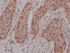 IHC image of CSB-RA911286A0HU diluted at 1:100 and staining in paraffin-embedded human cervical cancer performed on a Leica BondTM system. After dewaxing and hydration, antigen retrieval was mediated by high pressure in a citrate buffer (pH 6.0). Section was blocked with 10% normal goat serum 30min at RT. Then primary antibody (1% BSA) was incubated at 4°C overnight. The primary is detected by a Goat anti-rabbit IgG polymer labeled by HRP and visualized using 0.05% DAB.