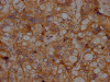 IHC image of CSB-RA243509A0HU diluted at 1:100 and staining in paraffin-embedded human liver cancer performed on a Leica BondTM system. After dewaxing and hydration, antigen retrieval was mediated by high pressure in a citrate buffer (pH 6.0). Section was blocked with 10% normal goat serum 30min at RT. Then primary antibody (1% BSA) was incubated at 4°C overnight. The primary is detected by a Goat anti-rabbit IgG polymer labeled by HRP and visualized using 0.05% DAB.