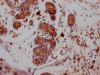 IHC image of CSB-RA159561A0HU diluted at 1:100 and staining in paraffin-embedded human breast cancer performed on a Leica BondTM system. After dewaxing and hydration, antigen retrieval was mediated by high pressure in a citrate buffer (pH 6.0). Section was blocked with 10% normal goat serum 30min at RT. Then primary antibody (1% BSA) was incubated at 4°C overnight. The primary is detected by a Goat anti-rabbit IgG polymer labeled by HRP and visualized using 0.05% DAB.