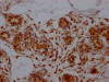 IHC image of CSB-RA826096A0HU diluted at 1:100 and staining in paraffin-embedded human breast cancer performed on a Leica BondTM system. After dewaxing and hydration, antigen retrieval was mediated by high pressure in a citrate buffer (pH 6.0). Section was blocked with 10% normal goat serum 30min at RT. Then primary antibody (1% BSA) was incubated at 4°C overnight. The primary is detected by a Goat anti-rabbit IgG polymer labeled by HRP and visualized using 0.05% DAB.