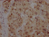 IHC image of CSB-RA916472A0HU diluted at 1:100 and staining in paraffin-embedded human liver cancer performed on a Leica BondTM system. After dewaxing and hydration, antigen retrieval was mediated by high pressure in a citrate buffer (pH 6.0). Section was blocked with 10% normal goat serum 30min at RT. Then primary antibody (1% BSA) was incubated at 4°C overnight. The primary is detected by a Goat anti-rabbit IgG polymer labeled by HRP and visualized using 0.05% DAB.