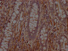IHC image of CSB-RA272100A0HU diluted at 1:100 and staining in paraffin-embedded human colon cancer performed on a Leica BondTM system. After dewaxing and hydration, antigen retrieval was mediated by high pressure in a citrate buffer (pH 6.0). Section was blocked with 10% normal goat serum 30min at RT. Then primary antibody (1% BSA) was incubated at 4°C overnight. The primary is detected by a Goat anti-rabbit IgG polymer labeled by HRP and visualized using 0.05% DAB.