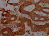 IHC image of CSB-RA252392A0HU diluted at 1:100 and staining in paraffin-embedded human colon cancer performed on a Leica BondTM system. After dewaxing and hydration, antigen retrieval was mediated by high pressure in a citrate buffer (pH 6.0). Section was blocked with 10% normal goat serum 30min at RT. Then primary antibody (1% BSA) was incubated at 4°C overnight. The primary is detected by a Goat anti-rabbit IgG polymer labeled by HRP and visualized using 0.05% DAB.