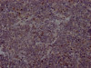 IHC image of CSB-RA942183A0HU diluted at 1:100 and staining in paraffin-embedded human lung cancer performed on a Leica BondTM system. After dewaxing and hydration, antigen retrieval was mediated by high pressure in a citrate buffer (pH 6.0). Section was blocked with 10% normal goat serum 30min at RT. Then primary antibody (1% BSA) was incubated at 4°C overnight. The primary is detected by a Goat anti-rabbit IgG polymer labeled by HRP and visualized using 0.05% DAB.