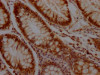 IHC image of CSB-RA194949A0HU diluted at 1:100 and staining in paraffin-embedded human colon cancer performed on a Leica BondTM system. After dewaxing and hydration, antigen retrieval was mediated by high pressure in a citrate buffer (pH 6.0). Section was blocked with 10% normal goat serum 30min at RT. Then primary antibody (1% BSA) was incubated at 4°C overnight. The primary is detected by a Goat anti-rabbit IgG polymer labeled by HRP and visualized using 0.05% DAB.
