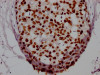 IHC image of CSB-RA246102A0HU diluted at 1:100 and staining in paraffin-embedded human breast cancer performed on a Leica BondTM system. After dewaxing and hydration, antigen retrieval was mediated by high pressure in a citrate buffer (pH 6.0). Section was blocked with 10% normal goat serum 30min at RT. Then primary antibody (1% BSA) was incubated at 4°C overnight. The primary is detected by a Goat anti-rabbit IgG polymer labeled by HRP and visualized using 0.05% DAB.