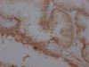 IHC image of CSB-RA286054A0HU diluted at 1:100 and staining in paraffin-embedded human prostate cancer performed on a Leica BondTM system. After dewaxing and hydration, antigen retrieval was mediated by high pressure in a citrate buffer (pH 6.0). Section was blocked with 10% normal goat serum 30min at RT. Then primary antibody (1% BSA) was incubated at 4°C overnight. The primary is detected by a Goat anti-rabbit IgG polymer labeled by HRP and visualized using 0.05% DAB.