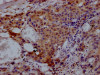 IHC image of CSB-RA182227A0HU diluted at 1:100 and staining in paraffin-embedded human breast cancer performed on a Leica BondTM system. After dewaxing and hydration, antigen retrieval was mediated by high pressure in a citrate buffer (pH 6.0). Section was blocked with 10% normal goat serum 30min at RT. Then primary antibody (1% BSA) was incubated at 4°C overnight. The primary is detected by a Goat anti-rabbit IgG polymer labeled by HRP and visualized using 0.05% DAB.