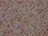 IHC image of CSB-RA182227A0HU diluted at 1:100 and staining in paraffin-embedded human glioma cancer performed on a Leica BondTM system. After dewaxing and hydration, antigen retrieval was mediated by high pressure in a citrate buffer (pH 6.0). Section was blocked with 10% normal goat serum 30min at RT. Then primary antibody (1% BSA) was incubated at 4°C overnight. The primary is detected by a Goat anti-rabbit IgG polymer labeled by HRP and visualized using 0.05% DAB.