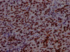 IHC image of CSB-RA569290A0HU diluted at 1:100 and staining in paraffin-embedded human bladder cancer performed on a Leica BondTM system. After dewaxing and hydration, antigen retrieval was mediated by high pressure in a citrate buffer (pH 6.0). Section was blocked with 10% normal goat serum 30min at RT. Then primary antibody (1% BSA) was incubated at 4°C overnight. The primary is detected by a Goat anti-rabbit IgG polymer labeled by HRP and visualized using 0.05% DAB.