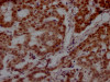 IHC image of CSB-RA160472A0HU diluted at 1:100 and staining in paraffin-embedded human breast cancer performed on a Leica BondTM system. After dewaxing and hydration, antigen retrieval was mediated by high pressure in a citrate buffer (pH 6.0). Section was blocked with 10% normal goat serum 30min at RT. Then primary antibody (1% BSA) was incubated at 4°C overnight. The primary is detected by a Goat anti-rabbit IgG polymer labeled by HRP and visualized using 0.05% DAB.