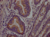 IHC image of CSB-RA259644A0HU diluted at 1:100 and staining in paraffin-embedded human colon cancer performed on a Leica BondTM system. After dewaxing and hydration, antigen retrieval was mediated by high pressure in a citrate buffer (pH 6.0). Section was blocked with 10% normal goat serum 30min at RT. Then primary antibody (1% BSA) was incubated at 4°C overnight. The primary is detected by a Goat anti-rabbit IgG polymer labeled by HRP and visualized using 0.05% DAB.