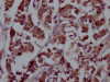 IHC image of CSB-RA927449A0HU diluted at 1:100 and staining in paraffin-embedded human breast cancer performed on a Leica BondTM system. After dewaxing and hydration, antigen retrieval was mediated by high pressure in a citrate buffer (pH 6.0). Section was blocked with 10% normal goat serum 30min at RT. Then primary antibody (1% BSA) was incubated at 4°C overnight. The primary is detected by a Goat anti-rabbit IgG polymer labeled by HRP and visualized using 0.05% DAB.
