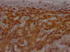 IHC image of CSB-RA581794A0HU diluted at 1:100 and staining in paraffin-embedded human breast cancer performed on a Leica BondTM system. After dewaxing and hydration, antigen retrieval was mediated by high pressure in a citrate buffer (pH 6.0). Section was blocked with 10% normal goat serum 30min at RT. Then primary antibody (1% BSA) was incubated at 4°C overnight. The primary is detected by a Goat anti-rabbit IgG polymer labeled by HRP and visualized using 0.05% DAB.