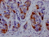 IHC image of CSB-RA264582A0HU diluted at 1:100 and staining in paraffin-embedded human liver cancer performed on a Leica BondTM system. After dewaxing and hydration, antigen retrieval was mediated by high pressure in a citrate buffer (pH 6.0). Section was blocked with 10% normal goat serum 30min at RT. Then primary antibody (1% BSA) was incubated at 4°C overnight. The primary is detected by a Goat anti-rabbit IgG polymer labeled by HRP and visualized using 0.05% DAB.