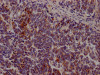 IHC image of CSB-RA206737A0HU diluted at 1:100 and staining in paraffin-embedded human lung cancer performed on a Leica BondTM system. After dewaxing and hydration, antigen retrieval was mediated by high pressure in a citrate buffer (pH 6.0). Section was blocked with 10% normal goat serum 30min at RT. Then primary antibody (1% BSA) was incubated at 4°C overnight. The primary is detected by a Goat anti-rabbit IgG polymer labeled by HRP and visualized using 0.05% DAB.