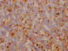 IHC image of CSB-RA449834A0HU diluted at 1:100 and staining in paraffin-embedded human breast cancer performed on a Leica BondTM system. After dewaxing and hydration, antigen retrieval was mediated by high pressure in a citrate buffer (pH 6.0). Section was blocked with 10% normal goat serum 30min at RT. Then primary antibody (1% BSA) was incubated at 4°C overnight. The primary is detected by a Goat anti-rabbit IgG polymer labeled by HRP and visualized using 0.05% DAB.