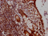 IHC image of CSB-RA231179A0HU diluted at 1:100 and staining in paraffin-embedded human colon cancer performed on a Leica BondTM system. After dewaxing and hydration, antigen retrieval was mediated by high pressure in a citrate buffer (pH 6.0). Section was blocked with 10% normal goat serum 30min at RT. Then primary antibody (1% BSA) was incubated at 4°C overnight. The primary is detected by a Goat anti-rabbit IgG polymer labeled by HRP and visualized using 0.05% DAB.