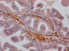 IHC image of CSB-RA186773A0HU diluted at 1:100 and staining in paraffin-embedded human prostate cancer performed on a Leica BondTM system. After dewaxing and hydration, antigen retrieval was mediated by high pressure in a citrate buffer (pH 6.0). Section was blocked with 10% normal goat serum 30min at RT. Then primary antibody (1% BSA) was incubated at 4°C overnight. The primary is detected by a Goat anti-rabbit IgG polymer labeled by HRP and visualized using 0.05% DAB.