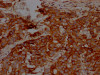 IHC image of CSB-RA256500A0HU diluted at 1:100 and staining in paraffin-embedded human breast cancer performed on a Leica BondTM system. After dewaxing and hydration, antigen retrieval was mediated by high pressure in a citrate buffer (pH 6.0). Section was blocked with 10% normal goat serum 30min at RT. Then primary antibody (1% BSA) was incubated at 4°C overnight. The primary is detected by a Goat anti-rabbit IgG polymer labeled by HRP and visualized using 0.05% DAB.