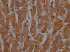 IHC image of CSB-RA286668A0HU diluted at 1:100 and staining in paraffin-embedded human breast cancer performed on a Leica BondTM system. After dewaxing and hydration, antigen retrieval was mediated by high pressure in a citrate buffer (pH 6.0). Section was blocked with 10% normal goat serum 30min at RT. Then primary antibody (1% BSA) was incubated at 4°C overnight. The primary is detected by a Goat anti-rabbit IgG polymer labeled by HRP and visualized using 0.05% DAB.