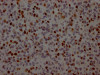 IHC image of CSB-RA825742A0HU diluted at 1:100 and staining in paraffin-embedded human glioma cancer performed on a Leica BondTM system. After dewaxing and hydration, antigen retrieval was mediated by high pressure in a citrate buffer (pH 6.0). Section was blocked with 10% normal goat serum 30min at RT. Then primary antibody (1% BSA) was incubated at 4°C overnight. The primary is detected by a Goat anti-rabbit IgG polymer labeled by HRP and visualized using 0.05% DAB.