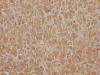 IHC image of CSB-RA794061A0HU diluted at 1:100 and staining in paraffin-embedded human glioma cancer performed on a Leica BondTM system. After dewaxing and hydration, antigen retrieval was mediated by high pressure in a citrate buffer (pH 6.0). Section was blocked with 10% normal goat serum 30min at RT. Then primary antibody (1% BSA) was incubated at 4°C overnight. The primary is detected by a Goat anti-rabbit IgG polymer labeled by HRP and visualized using 0.05% DAB.