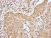 IHC image of CSB-RA794061A0HU diluted at 1:100 and staining in paraffin-embedded human cervical cancer performed on a Leica BondTM system. After dewaxing and hydration, antigen retrieval was mediated by high pressure in a citrate buffer (pH 6.0). Section was blocked with 10% normal goat serum 30min at RT. Then primary antibody (1% BSA) was incubated at 4°C overnight. The primary is detected by a Goat anti-rabbit IgG polymer labeled by HRP and visualized using 0.05% DAB.