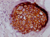 IHC image of CSB-RA260392A0HU diluted at 1:100 and staining in paraffin-embedded human breast cancer performed on a Leica BondTM system. After dewaxing and hydration, antigen retrieval was mediated by high pressure in a citrate buffer (pH 6.0). Section was blocked with 10% normal goat serum 30min at RT. Then primary antibody (1% BSA) was incubated at 4°C overnight. The primary is detected by a Goat anti-rabbit IgG polymer labeled by HRP and visualized using 0.05% DAB.
