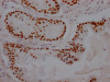 IHC image of CSB-RA217661A0HU diluted at 1:100 and staining in paraffin-embedded human prostate cancer performed on a Leica BondTM system. After dewaxing and hydration, antigen retrieval was mediated by high pressure in a citrate buffer (pH 6.0). Section was blocked with 10% normal goat serum 30min at RT. Then primary antibody (1% BSA) was incubated at 4°C overnight. The primary is detected by a Goat anti-rabbit IgG polymer labeled by HRP and visualized using 0.05% DAB.