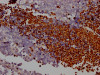 IHC image of CSB-RA258431A0HU diluted at 1:100 and staining in paraffin-embedded human lung cancer performed on a Leica BondTM system. After dewaxing and hydration, antigen retrieval was mediated by high pressure in a citrate buffer (pH 6.0). Section was blocked with 10% normal goat serum 30min at RT. Then primary antibody (1% BSA) was incubated at 4°C overnight. The primary is detected by a Goat anti-rabbit IgG polymer labeled by HRP and visualized using 0.05% DAB.