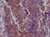 IHC image of CSB-RA181189A0HU diluted at 1:100 and staining in paraffin-embedded human lung cancer performed on a Leica BondTM system. After dewaxing and hydration, antigen retrieval was mediated by high pressure in a citrate buffer (pH 6.0). Section was blocked with 10% normal goat serum 30min at RT. Then primary antibody (1% BSA) was incubated at 4°C overnight. The primary is detected by a Goat anti-rabbit IgG polymer labeled by HRP and visualized using 0.05% DAB.