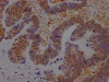 IHC image of CSB-RA981267A0HU diluted at 1:100 and staining in paraffin-embedded human ovarian cancer performed on a Leica BondTM system. After dewaxing and hydration, antigen retrieval was mediated by high pressure in a citrate buffer (pH 6.0). Section was blocked with 10% normal goat serum 30min at RT. Then primary antibody (1% BSA) was incubated at 4°C overnight. The primary is detected by a Goat anti-rabbit IgG polymer labeled by HRP and visualized using 0.05% DAB.