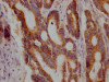 IHC image of CSB-RA227790A0HU diluted at 1:100 and staining in paraffin-embedded human colon cancer performed on a Leica BondTM system. After dewaxing and hydration, antigen retrieval was mediated by high pressure in a citrate buffer (pH 6.0). Section was blocked with 10% normal goat serum 30min at RT. Then primary antibody (1% BSA) was incubated at 4°C overnight. The primary is detected by a Goat anti-rabbit IgG polymer labeled by HRP and visualized using 0.05% DAB.