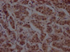 IHC image of CSB-RA898115A0HU diluted at 1:100 and staining in paraffin-embedded human breast cancer performed on a Leica BondTM system. After dewaxing and hydration, antigen retrieval was mediated by high pressure in a citrate buffer (pH 6.0). Section was blocked with 10% normal goat serum 30min at RT. Then primary antibody (1% BSA) was incubated at 4°C overnight. The primary is detected by a Goat anti-rabbit IgG polymer labeled by HRP and visualized using 0.05% DAB.