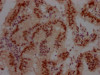 IHC image of CSB-RA898115A0HU diluted at 1:100 and staining in paraffin-embedded human prostate cancer performed on a Leica BondTM system. After dewaxing and hydration, antigen retrieval was mediated by high pressure in a citrate buffer (pH 6.0). Section was blocked with 10% normal goat serum 30min at RT. Then primary antibody (1% BSA) was incubated at 4°C overnight. The primary is detected by a Goat anti-rabbit IgG polymer labeled by HRP and visualized using 0.05% DAB.