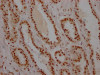 IHC image of CSB-RA192026A0HU diluted at 1:100 and staining in paraffin-embedded human prostate cancer performed on a Leica BondTM system. After dewaxing and hydration, antigen retrieval was mediated by high pressure in a citrate buffer (pH 6.0). Section was blocked with 10% normal goat serum 30min at RT. Then primary antibody (1% BSA) was incubated at 4°C overnight. The primary is detected by a Goat anti-rabbit IgG polymer labeled by HRP and visualized using 0.05% DAB.