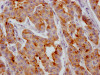 IHC image of CSB-RA225697A0HU diluted at 1:100 and staining in paraffin-embedded human breast cancer performed on a Leica BondTM system. After dewaxing and hydration, antigen retrieval was mediated by high pressure in a citrate buffer (pH 6.0). Section was blocked with 10% normal goat serum 30min at RT. Then primary antibody (1% BSA) was incubated at 4°C overnight. The primary is detected by a Goat anti-rabbit IgG polymer labeled by HRP and visualized using 0.05% DAB.