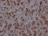 IHC image of CSB-RA987652A0HU diluted at 1:100 and staining in paraffin-embedded human breast cancer performed on a Leica BondTM system. After dewaxing and hydration, antigen retrieval was mediated by high pressure in a citrate buffer (pH 6.0). Section was blocked with 10% normal goat serum 30min at RT. Then primary antibody (1% BSA) was incubated at 4°C overnight. The primary is detected by a Goat anti-rabbit IgG polymer labeled by HRP and visualized using 0.05% DAB.