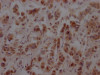 IHC image of CSB-RA986790A0HU diluted at 1:100 and staining in paraffin-embedded human breast cancer performed on a Leica BondTM system. After dewaxing and hydration, antigen retrieval was mediated by high pressure in a citrate buffer (pH 6.0). Section was blocked with 10% normal goat serum 30min at RT. Then primary antibody (1% BSA) was incubated at 4°C overnight. The primary is detected by a Goat anti-rabbit IgG polymer labeled by HRP and visualized using 0.05% DAB.